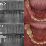 ビフォーアフター画像｜【症例】歯根破折を起こし抜歯になった奥歯の標準的なインプラント治療｜港南台の歯医者 港南台パーク歯科クリニック