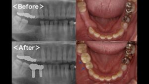 【症例】歯根破折を起こし抜歯になった奥歯の標準的なインプラント治療
