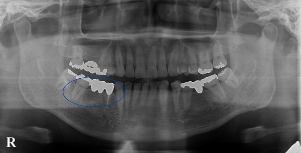 治療前レントゲン画像①｜【症例】歯根破折を起こし抜歯になった奥歯の標準的なインプラント治療｜港南台の歯医者 港南台パーク歯科クリニック