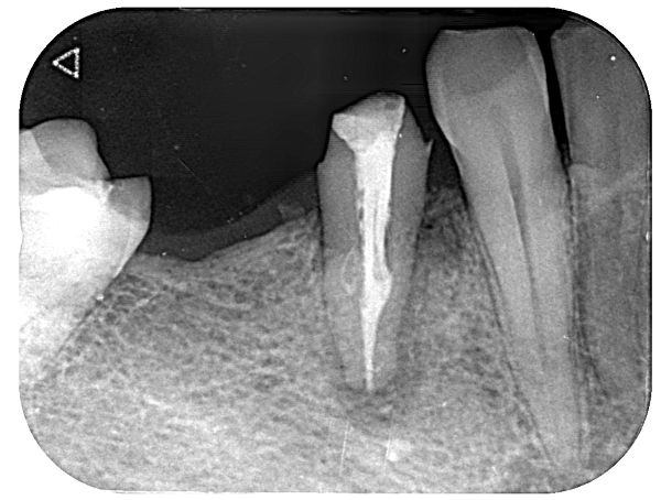 治療前レントゲン画像②｜【症例】歯根破折を起こし抜歯になった奥歯の標準的なインプラント治療｜港南台の歯医者 港南台パーク歯科クリニック