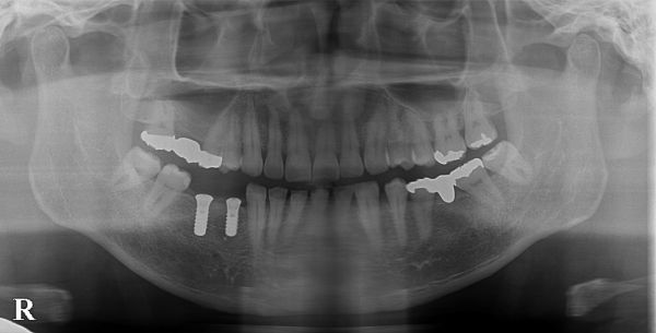 処置後レントゲン画像｜【症例】歯根破折を起こし抜歯になった奥歯の標準的なインプラント治療｜港南台の歯医者 港南台パーク歯科クリニック