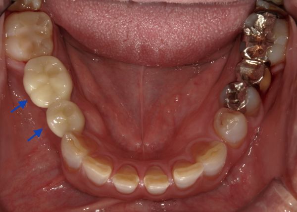 セット後口腔内写真｜【症例】歯根破折を起こし抜歯になった奥歯の標準的なインプラント治療｜港南台の歯医者 港南台パーク歯科クリニック