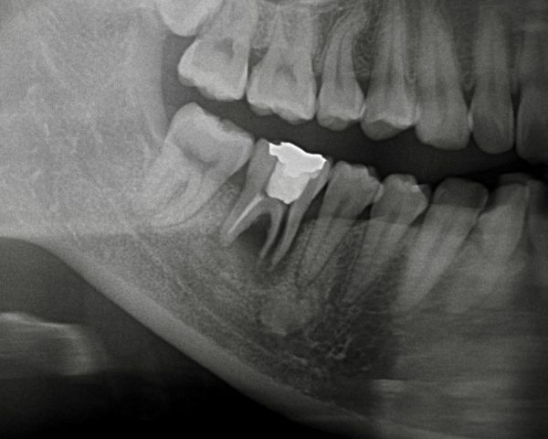 歯根破折レントゲン画像｜【症例】歯根破折を起こし抜歯になった奥歯の標準的なインプラント治療｜港南台の歯医者 港南台パーク歯科クリニック