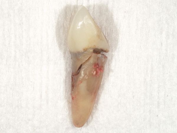 歯を失う画像｜【症例】歯根破折を起こし抜歯になった奥歯の標準的なインプラント治療｜港南台の歯医者 港南台パーク歯科クリニック