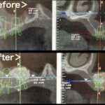 ビフォーアフター画像｜【症例】サイナスリフト（上顎洞挙上術）を用いたインプラント治療｜港南台の歯医者 港南台パーク歯科クリニック