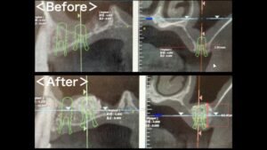 【症例】サイナスリフト(上顎洞挙上術)を用いたインプラント治療