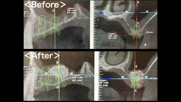 ビフォーアフター画像｜【症例】サイナスリフト（上顎洞挙上術）を用いたインプラント治療｜港南台の歯医者 港南台パーク歯科クリニック