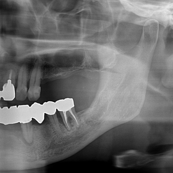 抜歯後3ヶ月のレントゲン写真｜【症例】サイナスリフト（上顎洞挙上術）を用いたインプラント治療｜港南台の歯医者 港南台パーク歯科クリニック