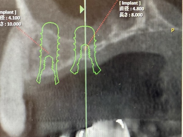 CTでの診断画像｜【症例】サイナスリフト（上顎洞挙上術）を用いたインプラント治療｜港南台の歯医者 港南台パーク歯科クリニック