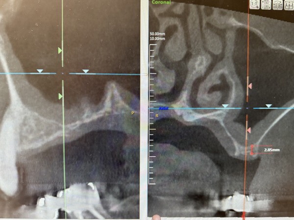 術前後のCT画像1｜【症例】サイナスリフト（上顎洞挙上術）を用いたインプラント治療｜港南台の歯医者 港南台パーク歯科クリニック