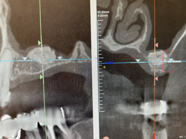 術前後のCT画像2｜【症例】サイナスリフト（上顎洞挙上術）を用いたインプラント治療｜港南台の歯医者 港南台パーク歯科クリニック