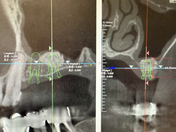 インプラントが埋め込まれている画像｜【症例】サイナスリフト（上顎洞挙上術）を用いたインプラント治療｜港南台の歯医者 港南台パーク歯科クリニック