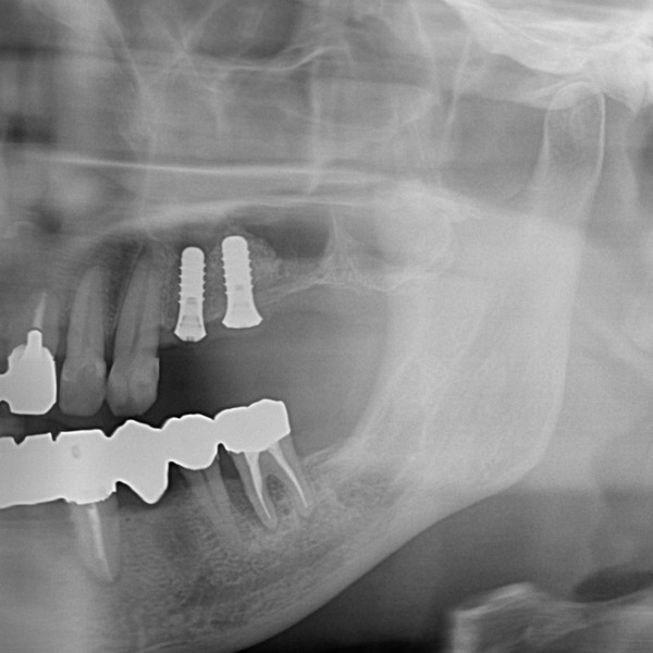 インプラント処置｜【症例】サイナスリフト（上顎洞挙上術）を用いたインプラント治療｜港南台の歯医者 港南台パーク歯科クリニック