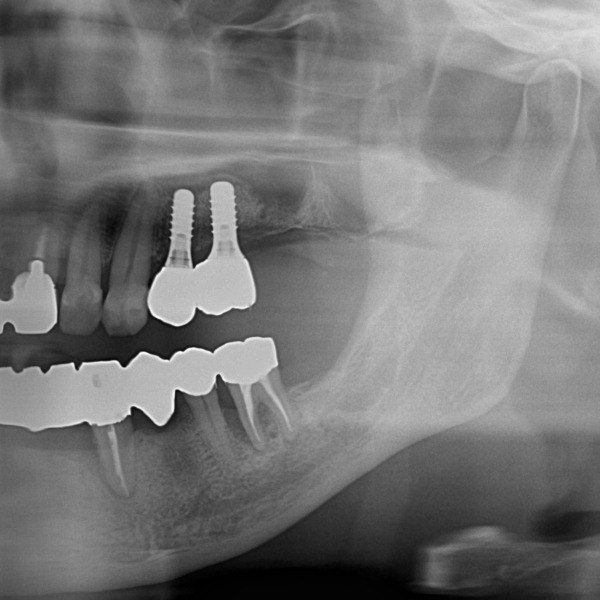 被せ物をセットした画像｜【症例】サイナスリフト（上顎洞挙上術）を用いたインプラント治療｜港南台の歯医者 港南台パーク歯科クリニック