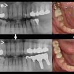 ビフォーアフター画像｜｜【症例】抜歯となった下顎の歯に対するインプラント治療｜港南台の歯医者 港南台パーク歯科クリニック｜港南台の歯医者 港南台パーク歯科クリニック