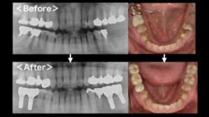 【症例】抜歯となった下顎の歯に対するインプラント治療