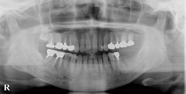初診時レントゲン画像｜【症例】抜歯となった下顎の歯に対するインプラント治療｜港南台の歯医者 港南台パーク歯科クリニック