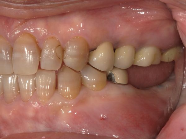 初診時画像｜【症例】抜歯となった下顎の歯に対するインプラント治療｜港南台の歯医者 港南台パーク歯科クリニック