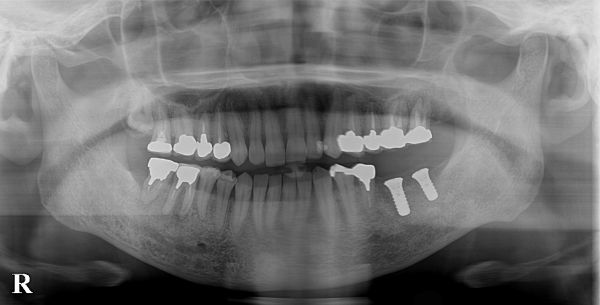 インプラント処置レントゲン画像｜【症例】抜歯となった下顎の歯に対するインプラント治療｜港南台の歯医者 港南台パーク歯科クリニック