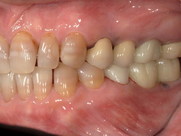 被せ物セット画像｜【症例】抜歯となった下顎の歯に対するインプラント治療｜港南台の歯医者 港南台パーク歯科クリニック