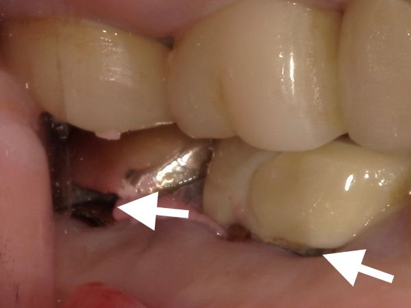 虫歯の画像｜【症例】抜歯となった下顎の歯に対するインプラント治療｜港南台の歯医者 港南台パーク歯科クリニック