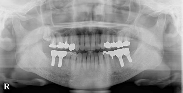 被せ物後レントゲン画像｜【症例】抜歯となった下顎の歯に対するインプラント治療｜港南台の歯医者 港南台パーク歯科クリニック