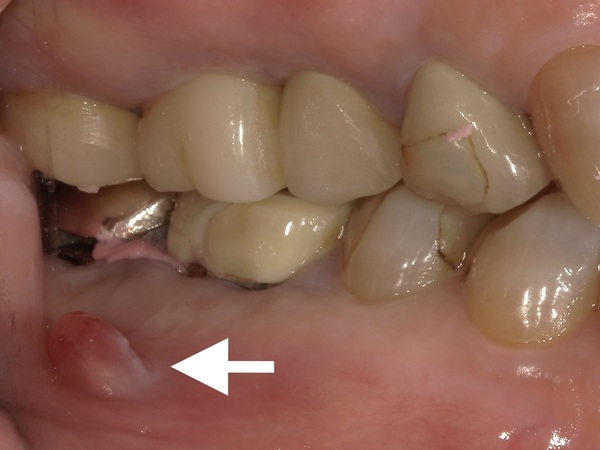 フィステルの画像｜【症例】虫歯で抜歯となった歯の下顎のインプラント治療｜港南台の歯医者 港南台パーク歯科クリニック