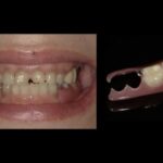 ノンクラスプデンチャー装着後の写真｜【症例】周囲に気づかれにくい審美的な入れ歯治療｜ノンクラスプデンチャー（スマイルデンチャー）｜港南台の歯医者 港南台パーク歯科クリニック