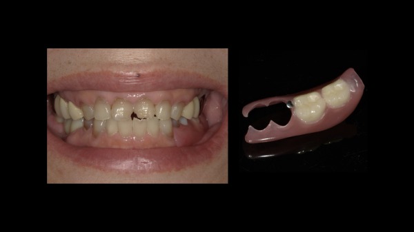 ノンクラスプデンチャー装着後の写真|【症例】周囲に気づかれにくい審美的な入れ歯治療|ノンクラスプデンチャー(スマイルデンチャー)|港南台の歯医者 港南台パーク歯科クリニック