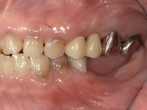 治療前|【症例】周囲に気づかれにくい審美的な入れ歯治療|ノンクラスプデンチャー(スマイルデンチャー)|港南台の歯医者 港南台パーク歯科クリニック