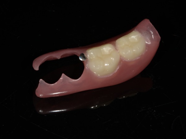 ノンクラスプデンチャー|【症例】周囲に気づかれにくい審美的な入れ歯治療|ノンクラスプデンチャー(スマイルデンチャー)|港南台の歯医者 港南台パーク歯科クリニック