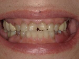 ノンクラスプデンチャー装着時の写真|【症例】周囲に気づかれにくい審美的な入れ歯治療|ノンクラスプデンチャー(スマイルデンチャー)|港南台の歯医者 港南台パーク歯科クリニック