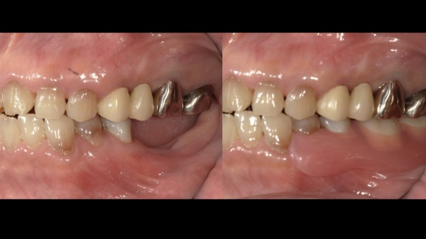 ビフォーアフター|【症例】周囲に気づかれにくい審美的な入れ歯治療|ノンクラスプデンチャー(スマイルデンチャー)|港南台の歯医者 港南台パーク歯科クリニック