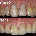 ビフォーアフター画像｜【症例】ジルコニアセラミックによる前歯の審美治療｜港南台の歯医者 港南台パーク歯科クリニック