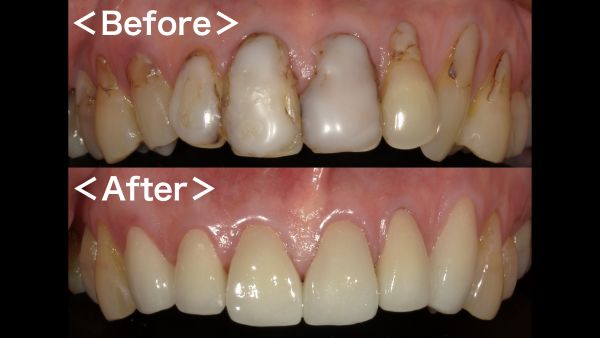 ビフォーアフター画像｜【症例】ジルコニアセラミックによる前歯の審美治療｜港南台の歯医者 港南台パーク歯科クリニック