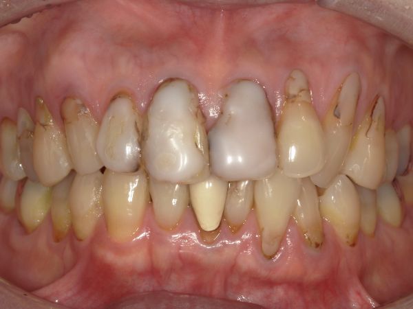 治療前画像｜【症例】ジルコニアセラミックによる前歯の審美治療｜港南台の歯医者 港南台パーク歯科クリニック