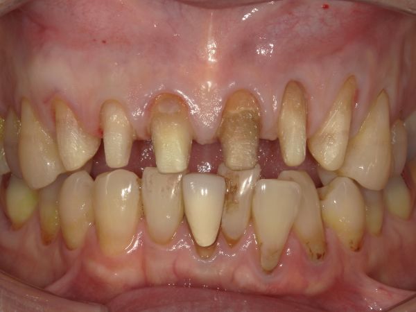 治療詳細画像1｜【症例】ジルコニアセラミックによる前歯の審美治療｜港南台の歯医者 港南台パーク歯科クリニック