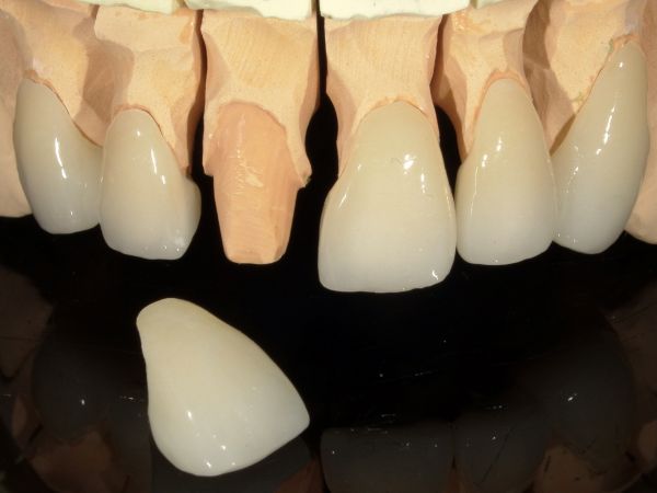 治療詳細画像2｜【症例】ジルコニアセラミックによる前歯の審美治療｜港南台の歯医者 港南台パーク歯科クリニック