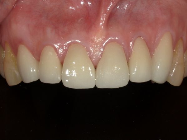 治療後画像｜【症例】ジルコニアセラミックによる前歯の審美治療｜港南台の歯医者 港南台パーク歯科クリニック
