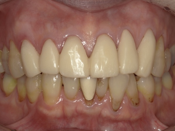 仮歯画像｜【症例】ジルコニアセラミックで昔のような自然な前歯を｜港南台の歯医者 港南台パーク歯科クリニック