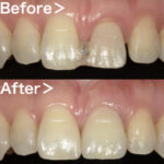 ビフォーアフター画像｜【症例】抜歯と同時に行う前歯のインプラント治療（抜歯即時埋入）｜港南台の歯医者 港南台パーク歯科クリニック