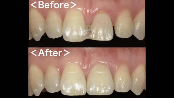 ビフォーアフター画像｜【症例】抜歯と同時に行う前歯のインプラント治療（抜歯即時埋入）｜港南台の歯医者 港南台パーク歯科クリニック