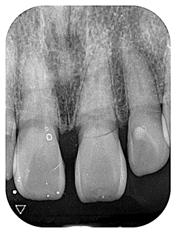 初診時レントゲン画像｜【症例】抜歯と同時に行う前歯のインプラント治療（抜歯即時埋入）｜港南台の歯医者 港南台パーク歯科クリニック