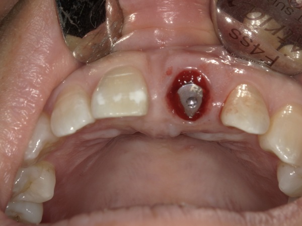 インプラント埋入画像｜【症例】抜歯と同時に行う前歯のインプラント治療（抜歯即時埋入）｜港南台の歯医者 港南台パーク歯科クリニック