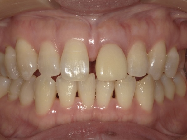 すきっ歯画像｜【症例】抜歯と同時に行う前歯のインプラント治療（抜歯即時埋入）｜港南台の歯医者 港南台パーク歯科クリニック