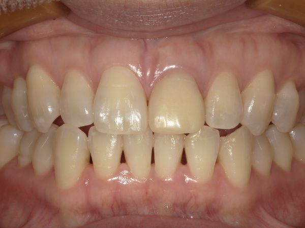 仮歯修正後画像｜【症例】抜歯と同時に行う前歯のインプラント治療（抜歯即時埋入）｜港南台の歯医者 港南台パーク歯科クリニック