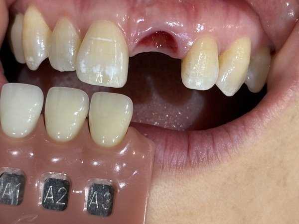 型取りと色合わせ画像｜【症例】抜歯と同時に行う前歯のインプラント治療（抜歯即時埋入）｜港南台の歯医者 港南台パーク歯科クリニック