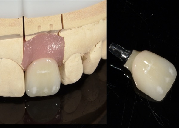 被せ物画像｜【症例】抜歯と同時に行う前歯のインプラント治療（抜歯即時埋入）｜港南台の歯医者 港南台パーク歯科クリニック