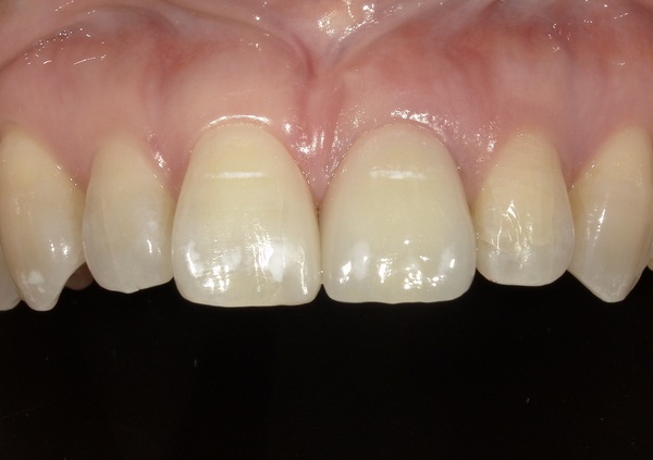 治療後口腔内画像｜【症例】抜歯と同時に行う前歯のインプラント治療（抜歯即時埋入）｜港南台の歯医者 港南台パーク歯科クリニック