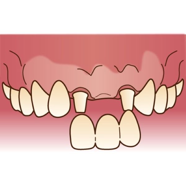 ブリッジのイラスト|歯が抜けた状態、放置しても大丈夫?|港南台の歯医者 港南台パーク歯科クリニック